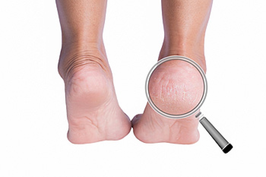 What Really Causes Cracked Heels—and How to Get Rid of Them